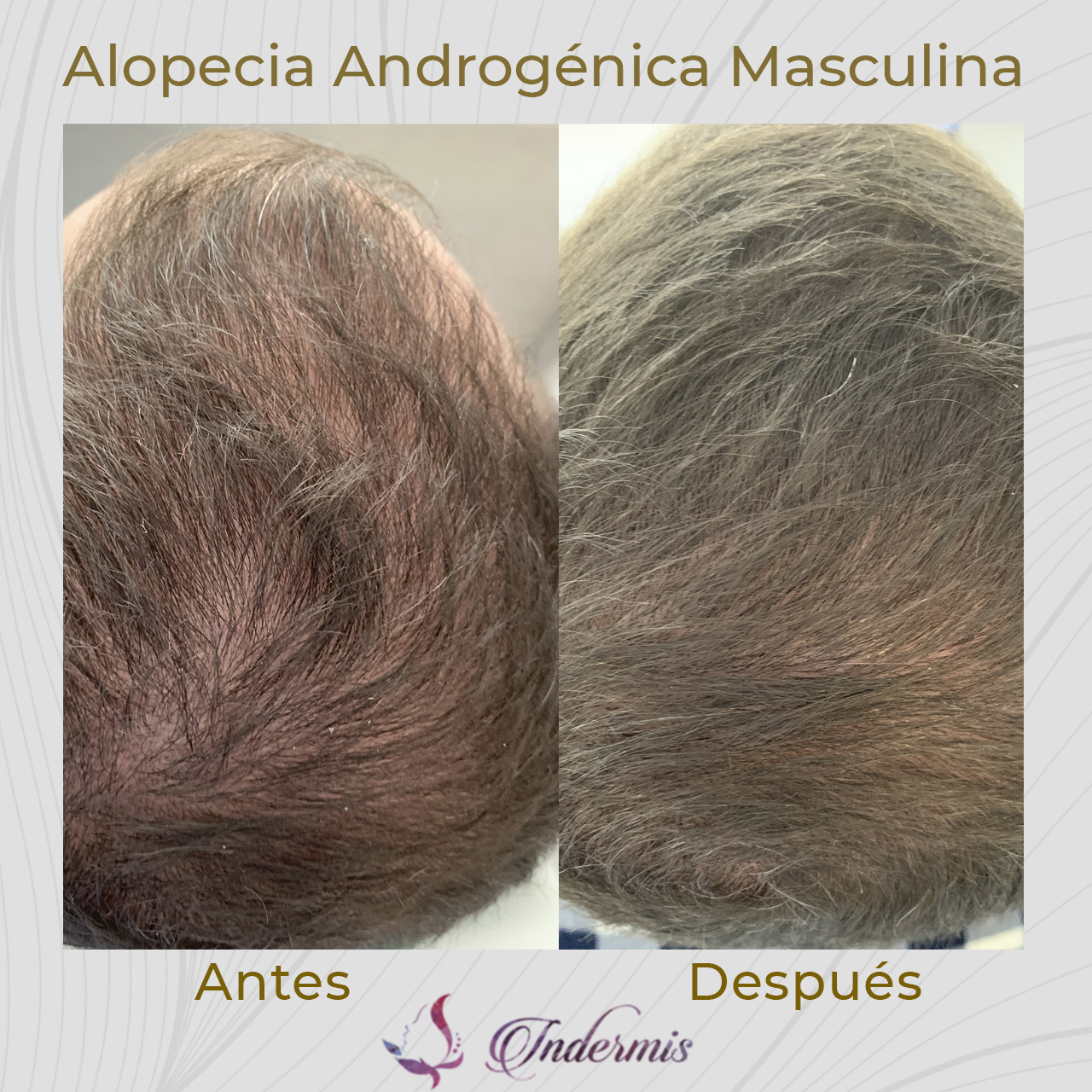 alopecia_01