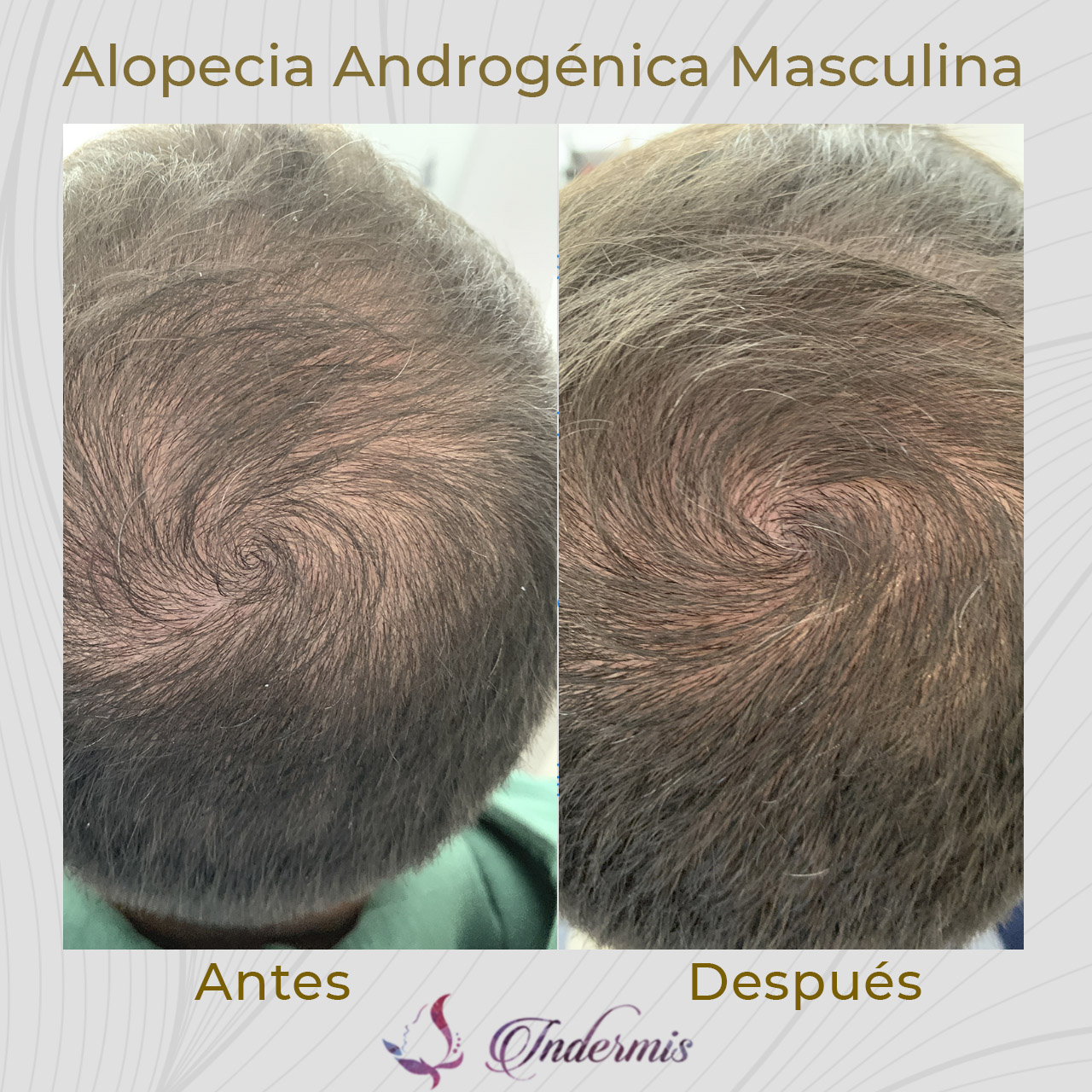 alopecia_02