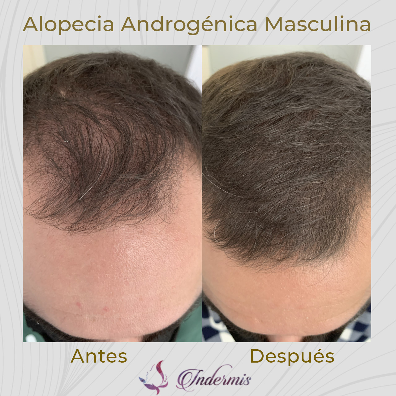 alopecia_03