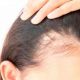 indermis alopecia androgenicafemenina