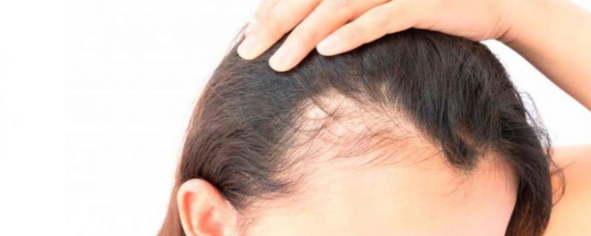 indermis alopecia androgenicafemenina